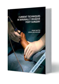 Current techniques in minimally invasive foot surgery